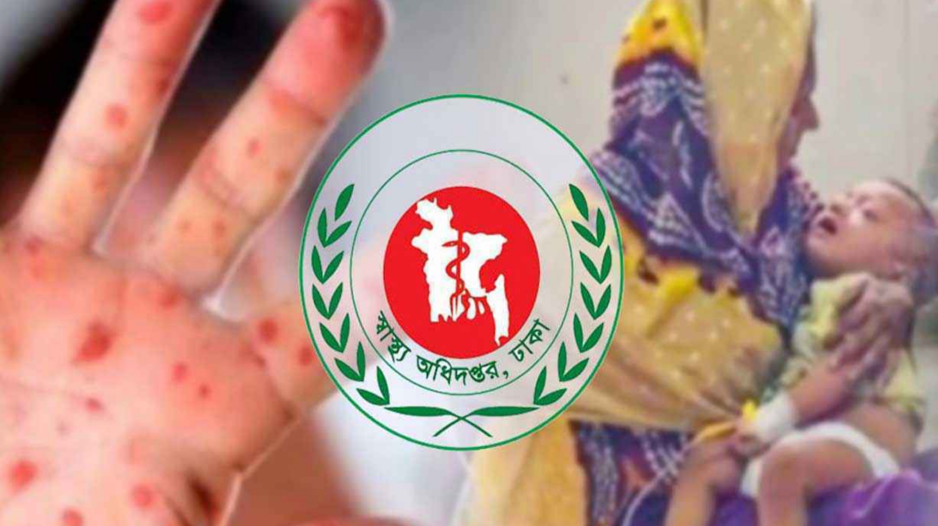 হাম উপসর্গে ৪ শিশুর মৃত্যু