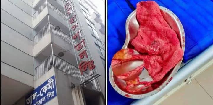 আলকেমী হসপিটালে সিজারের ৭মাস পর প্রসূতির পেটে মিলল এক ফুট গজ কাপড়
