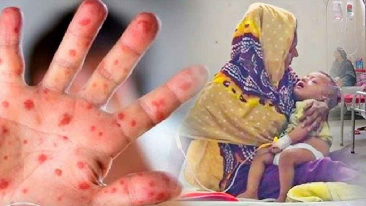 হাম ও উপসর্গে ২৪ ঘণ্টায় ৯ শিশুর মৃত্যু, হাসপাতালে ভর্তি ১৪৩৫