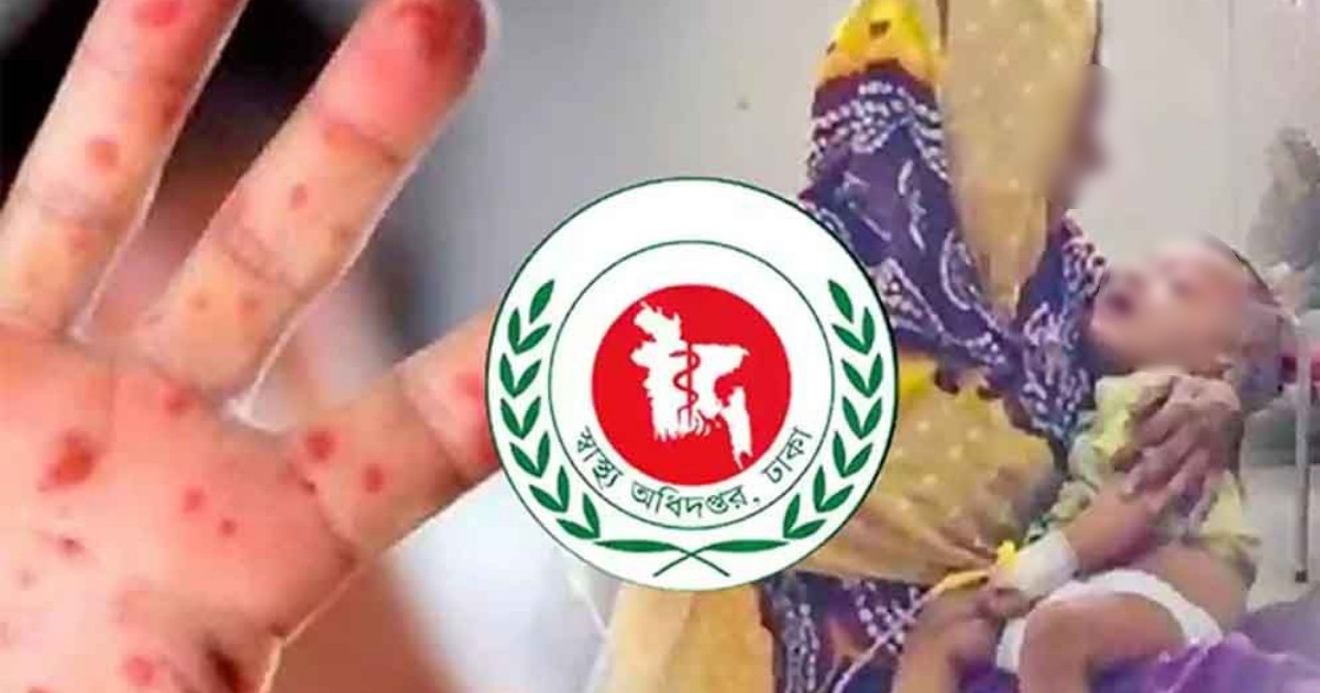হাম ও উপসর্গে দেশে মৃত্যু ৫০০ ছুঁইছুঁই, সবচেয়ে বেশি ঢাকায়